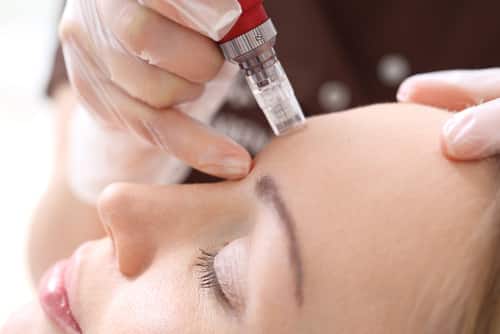 Microneedling dans les ardennes - charleville - auvillers les forges - hirson - estheticienne